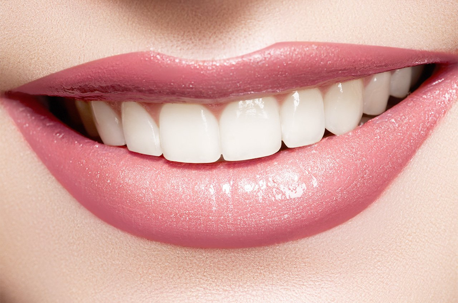 Teeth Whitening